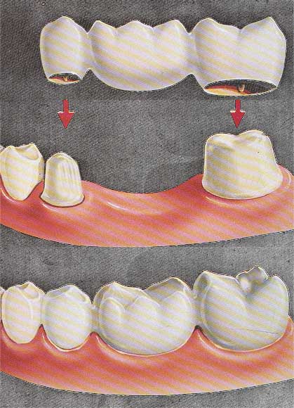 Dental-Crowns-as-bridge retainers 