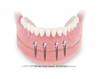 mini-dental-implat-overdenture
